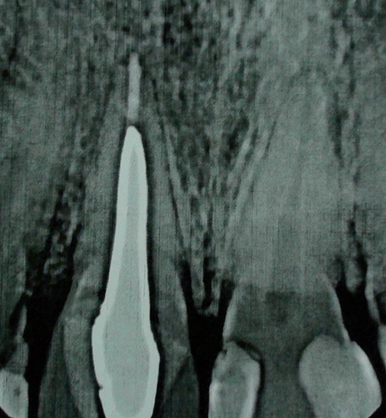 внутриротовая прицельная рентгенограмма зуба 1.1 после фиксации фарфоровой коронки для контроля качества краевого прилегания