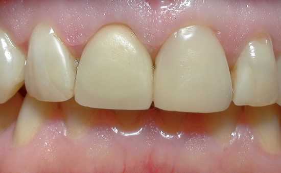 состояние десневого края после фиксации фарфоровой коронки на зубе 1.1 