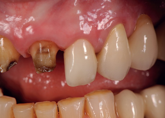 Рис. 14. Гармоничный переход от коронки (в области зуба 22) к натуральному зубу (23)