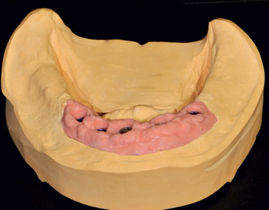 Рис. 1. Исходная ситуация: в нижнюю челюсть с полным отсутствием зубов внедрены 5 имплантатов Camlog