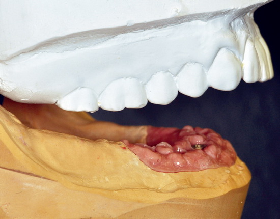 Рис. 2. Проблема: нижняя челюсть смещена кзади. Риск опрокидывания зубного протеза