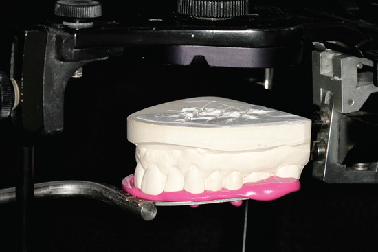 Рис. 12. Окклюзионные поверхности зубов модели верхней челюсти в точности соответствуют регистратору прикуса