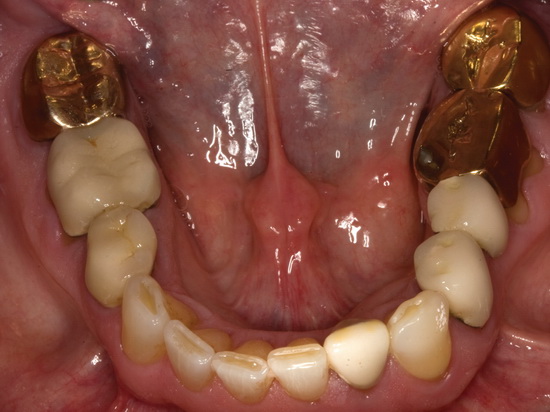 Рис. 2. Клинический вид стертой окклюзионной поверхности золотой коронки в области опорного зуба № 19