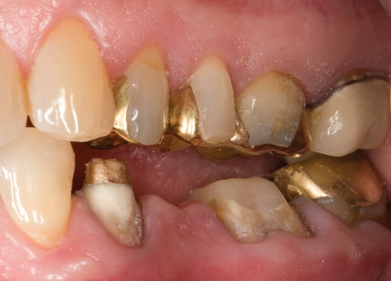 Рис. 7. Клинический вид препарированных зубов