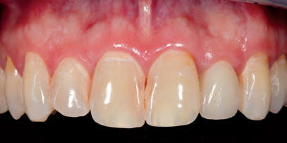 Рис. 1. Исходная ситуация: выраженная деминерализация и кариес зубов 12–22. Уже проведена ретракция десны верхней челюсти