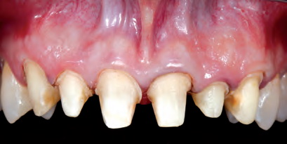 Рис. 2. Зубы 12–22 препарированы под фиксацию коронок