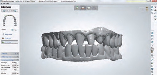 Рис. 5. Отсканированные препарированные зубы с противоположной челюстью