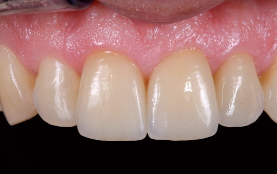 Рис. 12. Система e.max, в которую всё включено, значительно упрощает рутинную работу в зуботехнической лаборатории