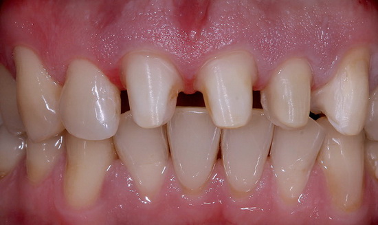 Рис. 2 и 3. Минимально инвазивное препарирование с максимальным сохранением структуры зубов