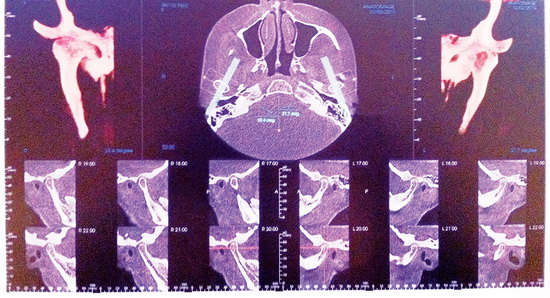 Рис. 3. Компьютерная томограмма височнонижнечелюстного сустава пациентки на момент обращения в клинику