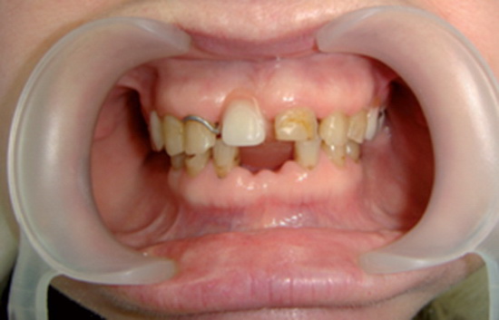 Рис. 6. Состояние полости рта пациентки на этапе сплинт-терапии