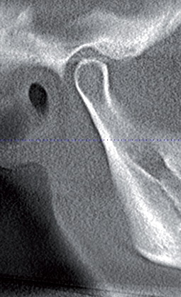 Рис.7а. Компьютерная томограмма ВНЧС справа на этапе сплинт-терапии