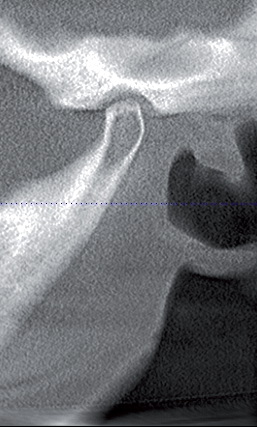 Рис.7б. Компьютерная томограмма ВНЧС слева на этапе сплинт-терапии