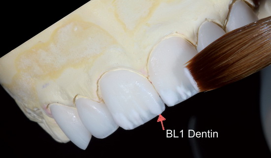Рис. 20. После обжига внутренних красителей, на вестибулярные доли был нанесён дентин BL1 и распределён так, чтобы имитировать особенности окраски натуральных зубов. Подпись на рисунке: дентин BL1