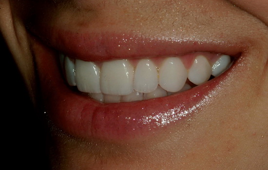 Рис. 37. Вид слева улыбки пациентки после завершения лечения