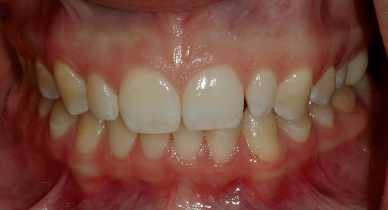 Рис. 5. Вид пациентки до начала лечения (снимок с губным ретрактором)