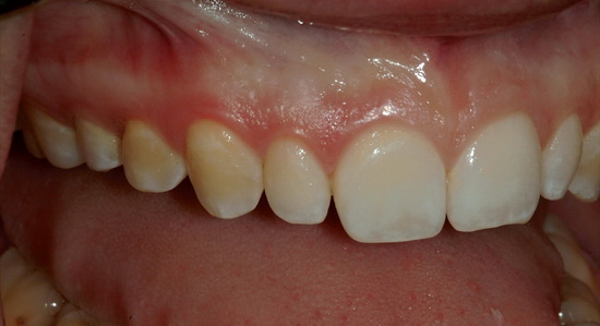 Рис. 6. Пациентка до начала лечения, вид справа (снимок с губным ретрактором)