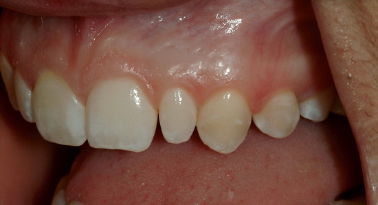 Рис. 7. Пациентка до начала лечения, вид слева (снимок с губным ретрактором)