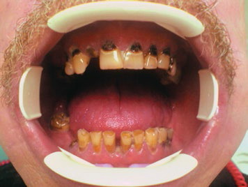 Рис.1. Лучевой некроз зубов после курса лучевой терапии (54 г)