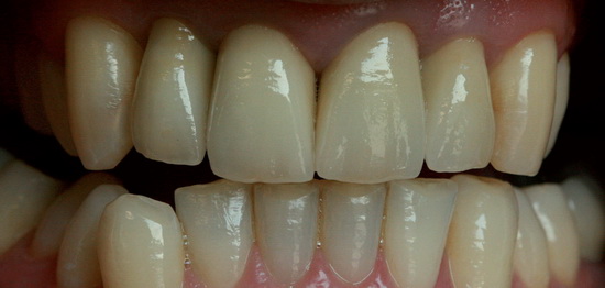 Рис. 11. Форма и функция: кромки режущего края зубов верхней челюсти гармонично сочетаются с кромками зубов нижней челюсти