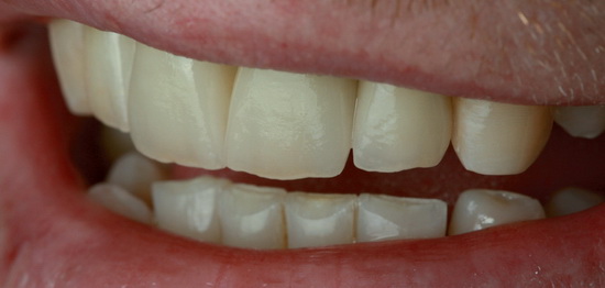 Рис. 12. Естественный блеск поверхности: реставрации, облицованные VMK Master, оправдывают ожидания стоматолога и пациента