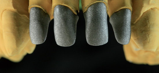Рис. 2. Металлические каркасы с обрезанной вестибулярной кромкой для керамического плеча