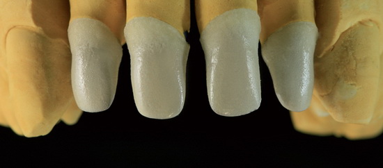 Рис. 3. Обожженный опаковый слой. Керамическое плечо формируется с помощью флуоресцирующей пришеечной массы