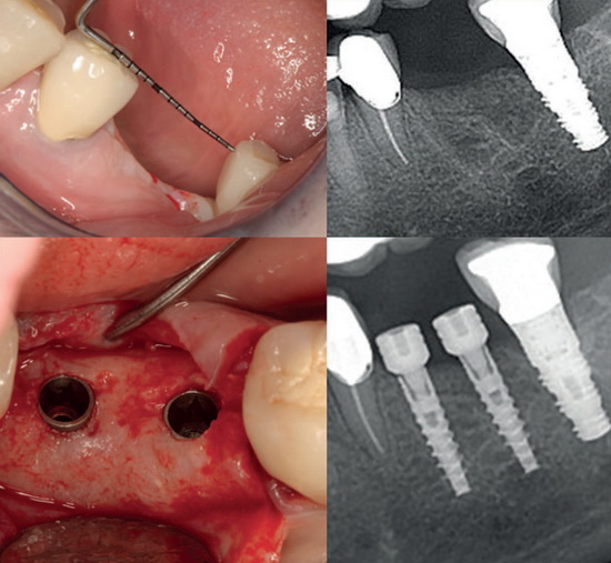 Рис. 1. Замена моляра с помощью 2-х узких зубных имплантатов.