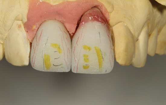 Рис. 14. Воспроизведение формы вестибулярных долей и текстуры поверхности зуба