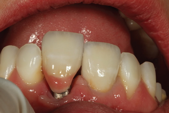 Рис. 17. Примерка реставрации зуба 9