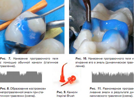 Протокол адгезивной фиксации керамических реставраций презентация