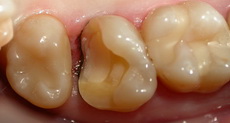   Восстановление зубов керамическими вкладками
