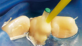  Восстановление зубов 