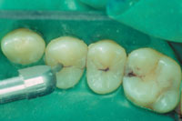 Минимальное стоматологическое вмешательство