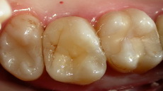   Восстановление зубов керамическими вкладками