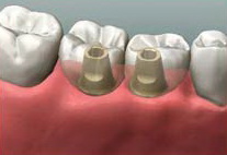 Имплантация и протезирование зубов