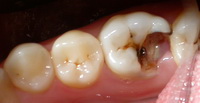 зуб разрушенный кариесом
