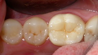 Зуб, восстановленный керамической коронкой