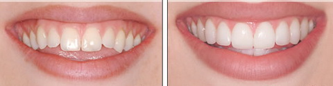 реставрация зубов люминирами