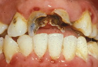 Зубы, разрушенные кариесом