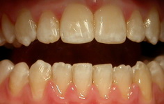 Изменение цвета зубов после профессионального отбеливания