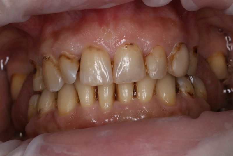 Исходное состояние - зубы в сомкнутом состоянии