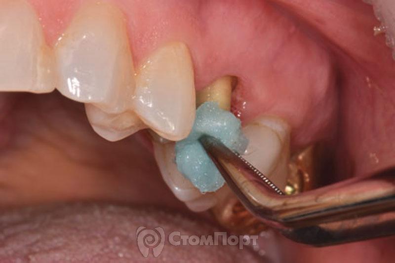 2. Обработка культи зуба хлоргексидином