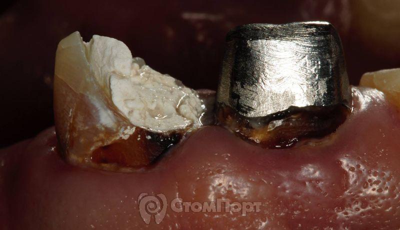 24. Вид зубов 1.1 и 2.1 в ротовой полости после проведённого эндодонтического лечения