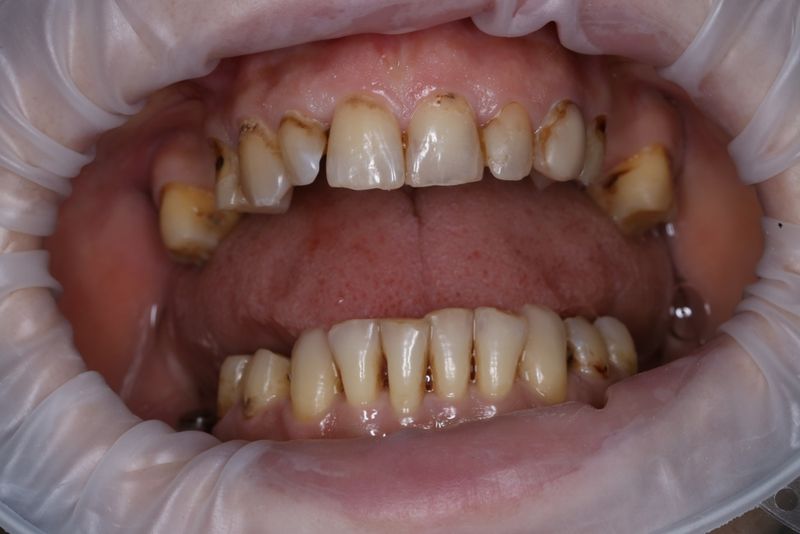 Исходное состояние - зубы в разомкнутом состоянии