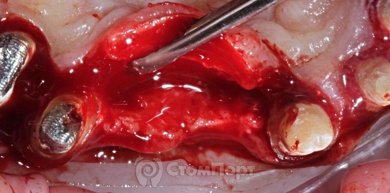 3. Ширина гребня не позволяет установить имплантаты в правильной ортопедической позиции