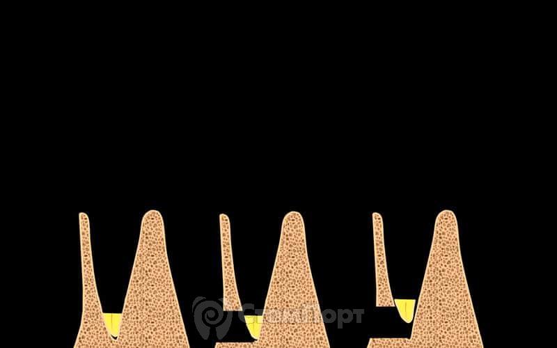 7. Резекция верхушки корня зуба (латеральная апексэктомия)