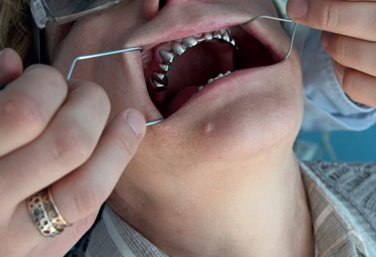 Рис. 2. Вид каркасов несъемных мостовидных протезов в полости рта пациентки