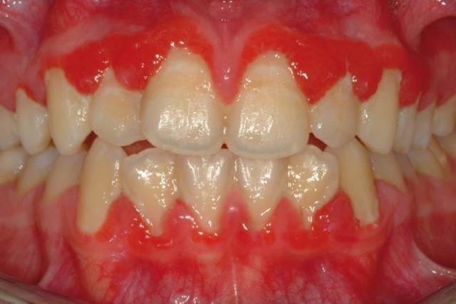 Гингивит гипертрофический (беременных)