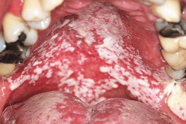 Кандидоз (молочница) полости рта – симптомы и лечение